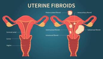 Uterine fibroids scheme on dark blue background vector