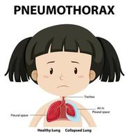 Pneumothorax diagram of human anatomy vector