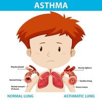 diagrama de asma con pulmón normal y pulmón asmático vector