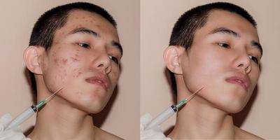 Young man with before and after treatment from acne and pimple. photo