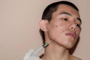 las cicatrices y arrugas causadas por el acné en la piel por hormonas o suciedad. foto