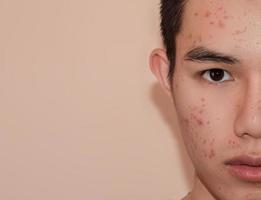 The scars and wrinkle caused by acne on skin by Hormone or grime. photo