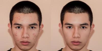 Young man with before and after treatment from acne and pimple. photo