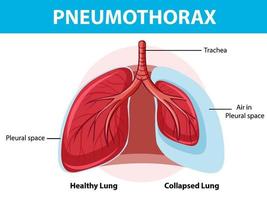 Pneumothorax diagram with collapsed lung and healthy lung vector