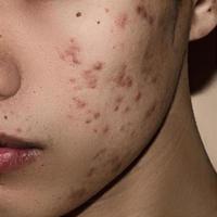 Cerca de acné en la piel, acné en la cara causado por hormonas.