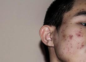 Close up of acne on the skin, Acne on the face caused by Hormone. photo