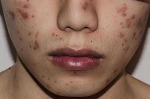 Close up of acne on the skin, Acne on the face caused by Hormone. photo