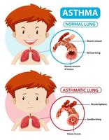 Asthma diagram with normal lung and asthmatic lung vector