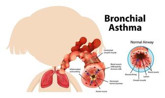 Bronchial Asthma diagram with normal airway and asthmatic airway vector