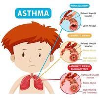 Asthma diagram with normal airway and asthmatic airway vector