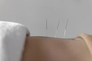 Cerrar procedimiento de acupuntura. resolución y hermosa foto de alta calidad