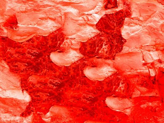 Cerebral Hemorrhage Stock Photos Images And Backgrounds For Free Download Cerebral Hemorrhage Stock Photos Images And Backgrounds For Free Download