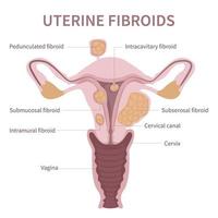 Diagrama de fibromas uterinos de la mujer sobre fondo blanco. vector