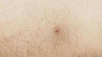 The acne on the leg skin. Nodular cystic acne skin photo