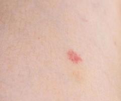 Small petechiae on the leg photo