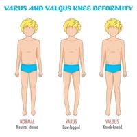 Varus valgus stance chart infographic vector