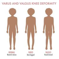 Valgus, varus knee, legs disease, deformation infographic vector