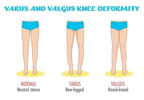 Valgus and varus foot standing vector