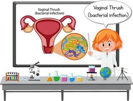 Joven médico explicando la infección bacteriana candidiasis vaginal vector