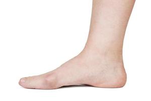 Human foot with hallux valgus