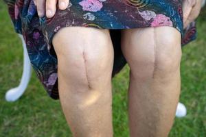 Señora mayor asiática anciana paciente mostrar sus cicatrices quirúrgico reemplazo total de la articulación de la rodilla foto