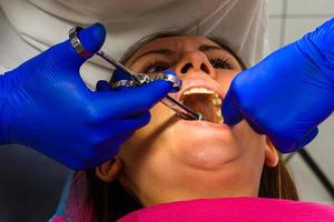 anestesia local, el dentista utiliza una jeringa carpiana, foto
