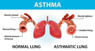 diagrama de asma bronquial con pulmón normal y pulmón asmático vector