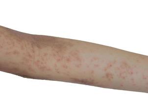 Skin rash on the arms isolated a white background. photo