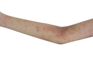 Skin rash on the arms isolated a white background. photo