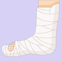 Broken leg in in a cast bandage, orthopedic gypsum, injury bone, vector illustration drawn in a flat style. Vector illustration.