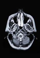 A real MRI MRA of the brain vasculature photo