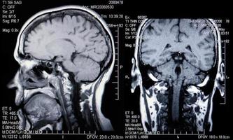 resonancias magnéticas reales de la cabeza y el cerebro foto