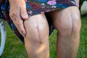 paciente asiática anciana muestra sus cicatrices reemplazo total quirúrgico de la articulación de la rodilla. foto