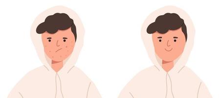 Teenage boy with acne before and after flat vector illustration isolated on white background. Set of male person with unhappy face with acne and happy clean skin.