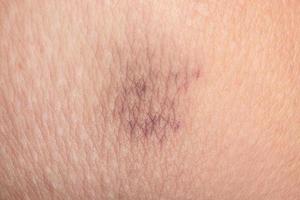 bruise on the skin close up, capillaries on damaged skin photo