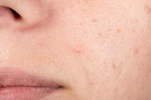 acne on a woman face, white and black pimples on the girl skin photo