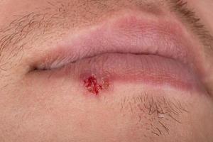 wound on the lower lip herpes cutaneous autoimmune disease