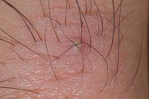 Inflammation caused by ingrown hair photo