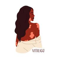 Beautiful woman with the skin disease vitiligo. World Vitiligo Day. Acceptance of your appearance, self-love. Vector illustration in flat style