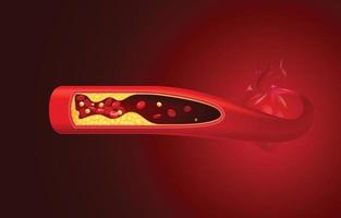 los glóbulos rojos y el colesterol se obstruyen antes del corazón. vector
