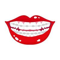 Vector cartoon smiling mouth with stages of teeth alignment using orthodontic metal braces.