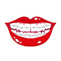 Vector cartoon smiling mouth with stages of crooked teeth alignment using orthodontic metal braces.