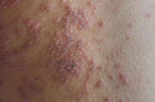 Close-up of skin rashes caused by allergies. photo