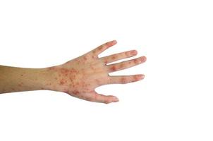 Rash and skin on the hand, isolated on white background. photo