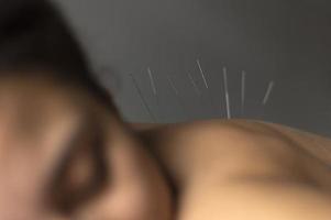 close up patient during acupuncture procedure. High quality beautiful photo concept