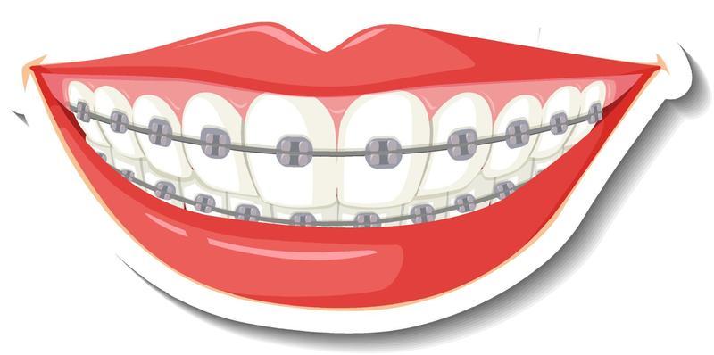 Teeth with braces on white background