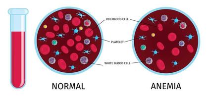 tabla de anemia de células sanguíneas vector