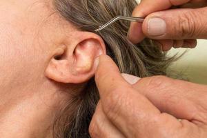 Woman who had ear acupuncture treatment done having the ear studs removed photo