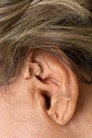 Woman who had ear acupuncture treatment done having the ear studs removed photo