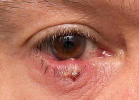 Man with a huge stye on his eyelid photo